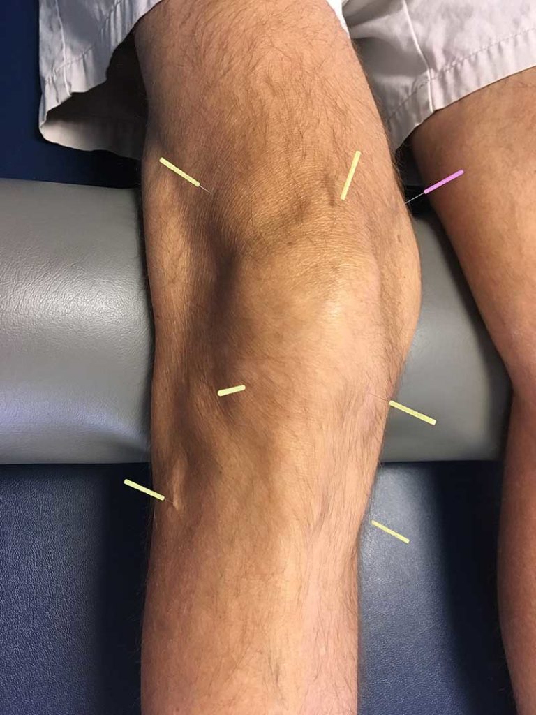 Dry Needling Longmont