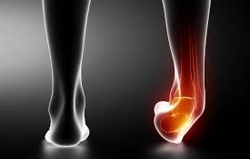 Ankle Sprains